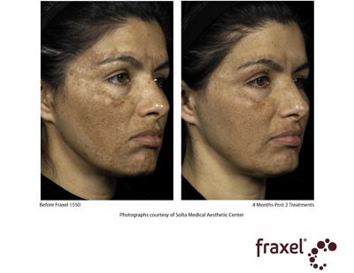 Female face, before and after Chemical Peels treatment, oblique view, patient 1