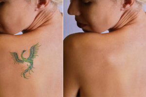 Which Tattoo Colors can be Effectively Removed?