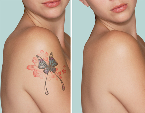 Woman shoulder, before and after effectively removed tattoo