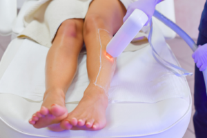 Waiting Times Between Laser Treatments
