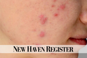 Cystic Acne: Not All Blemishes Are Created Equal