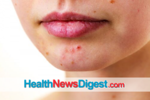 Cystic Acne: Not All Blemishes Are Created Equal