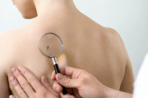 Self-Examination for Suspicious Moles
