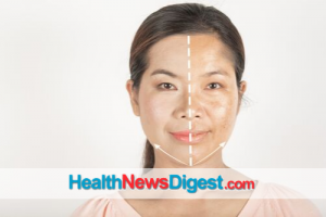 5 Facts About Treating Melasma