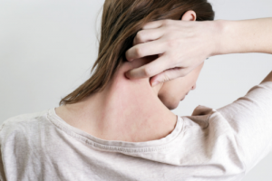 Eczema and Steroid Cream Addiction