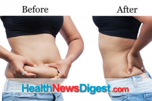 Latest Fat-Trimming Techniques Effective — Not Miraculous, Experts Say