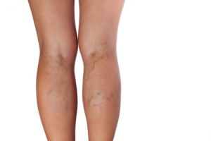 7 Things You Need to Know About Leg Veins