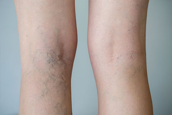 Patient leg veins, before treatment photo