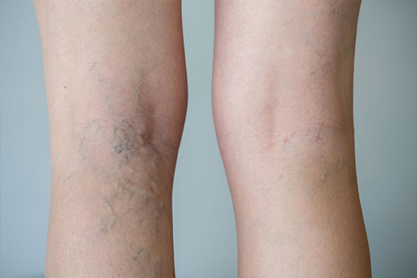 LEG VEINS: WHY THEY APPEAR AND HOW DERMATOLOGISTS TREAT THEM