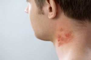 Seasonal Skin Rash? Stay Ahead of Your Autumn Allergies