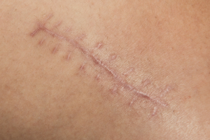 Extreme Scars: Stop a Keloid from Growing