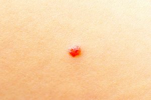 Angiomas: Red Flag or Benign Skin Growth?