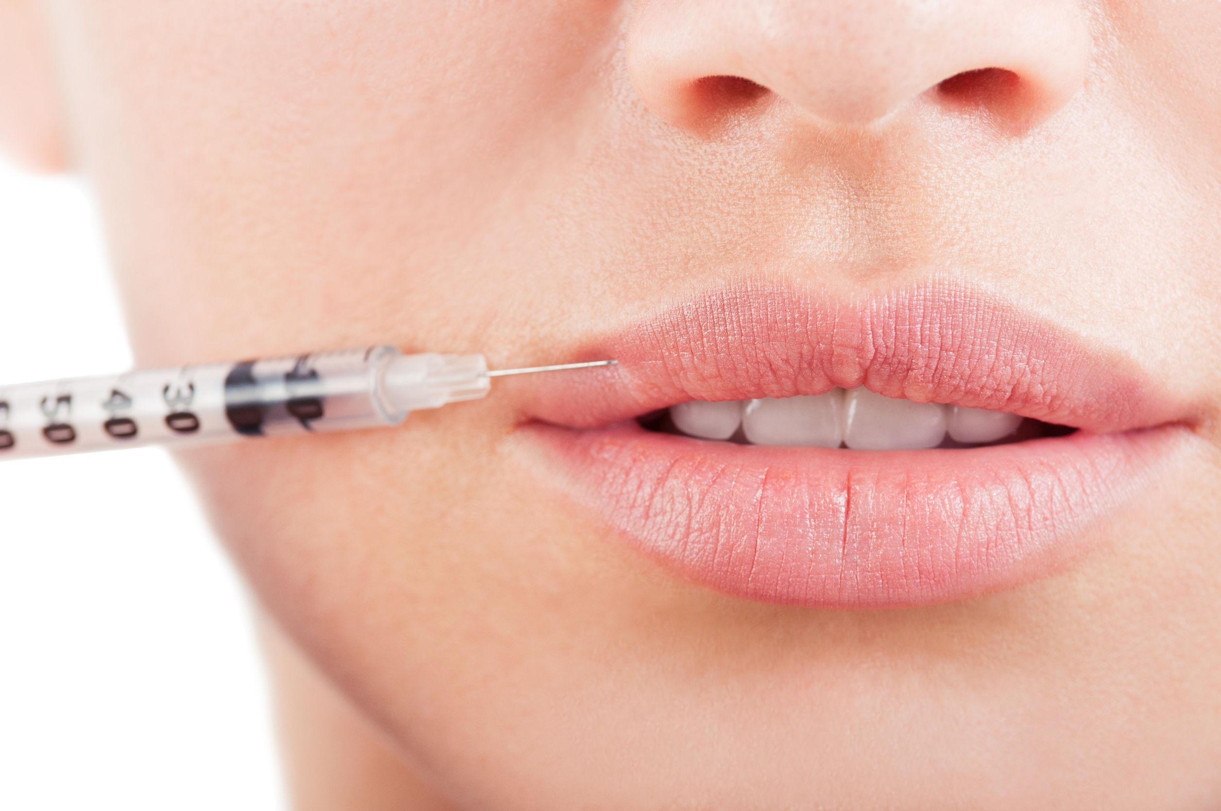 Woman's lips, filler injection