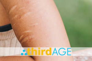 Scar Wars: Winning the Battle Against Keloids