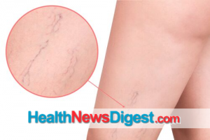 Getting the Red Out: Addressing the Appearance of Broken Blood Vessels