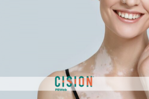 Managing the Skin-Whitening Condition Vitiligo