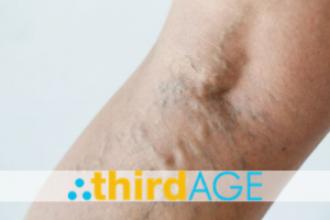 Spider Veins: Addressing the Appearance of Broken Blood Vessels