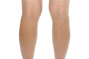Getting the Red Out: Addressing the Appearance of Broken Blood Vessels