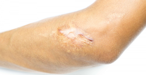 Scar Wars: Winning the Battle Against Keloids