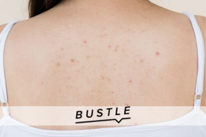 7 Unexpected Things Having Acne On Your Back Says About Your Health Habits
