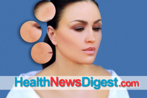 3 Key Facts and Myths About Melasma