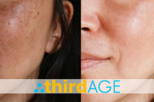 3 Key Facts and Myths About Melasma
