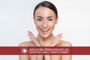 Advanced Dermatology’s, Robert Ecker, M.D. Speaks on Acne (Acne Overview)
