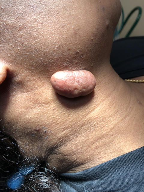 Keloid Treatment Service Photo1