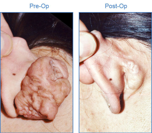 Keloid Treatment Service Photo2