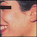 Acne patient after photo