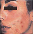 Acne patient before photo
