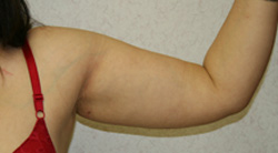 Arm Lift patient after photo