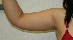 Arm Lift patient after photo