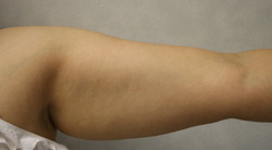 Arm Lift patient before photo