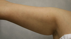 Arm Lift patient before photo