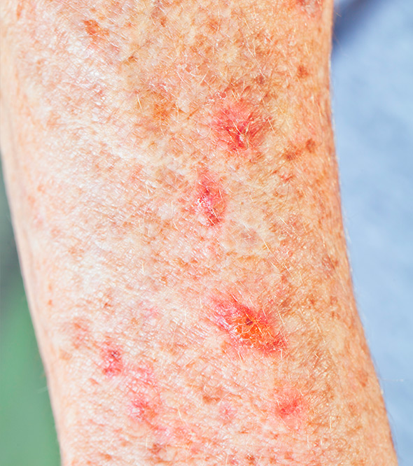 What Are The Warning Signs Of Actinic Keratosis At Isabel Newell Blog