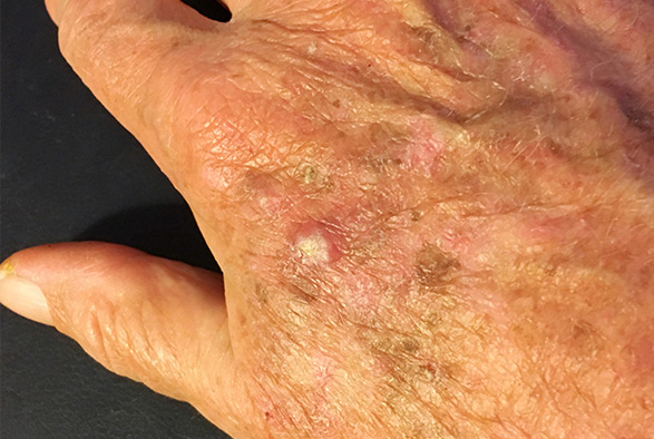 Actinic Keratosis Service Photo2