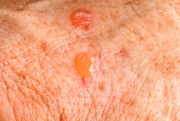 Actinic Keratosis Service Photo3