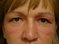 Liposculpture and Fat Transfer patient after photo