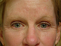 Liposculpture and Fat Transfer patient after photo