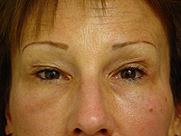 Liposculpture and Fat Transfer patient after photo