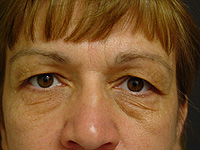 Liposculpture and Fat Transfer patient before photo