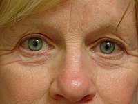 Liposculpture and Fat Transfer patient before photo