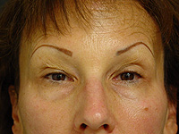 Liposculpture and Fat Transfer patient before photo