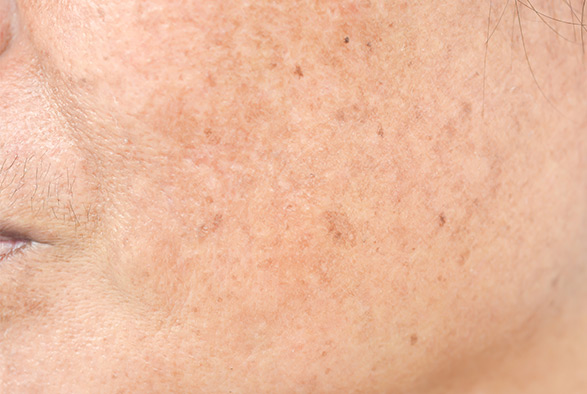 Erbium Laser Skin Resurfacing Service Photo1