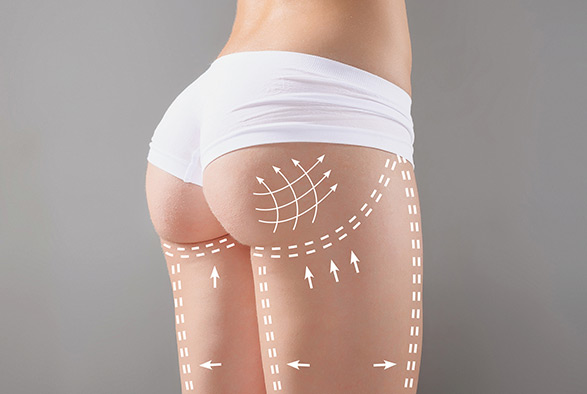 Non-Surgical Buttock Enhancement Service Photo2