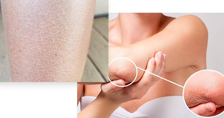 Dry Skin (Xerosis) Service Photo1