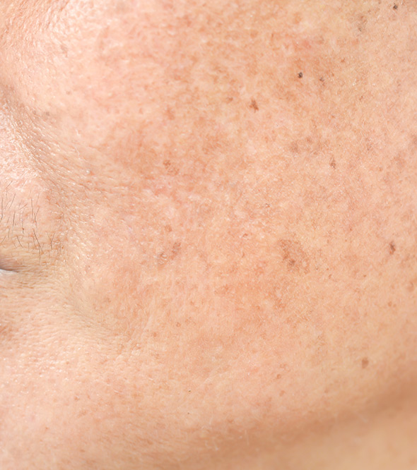 Eclipse MicroPen Elite (Skin Resurfacing) Service Photo2