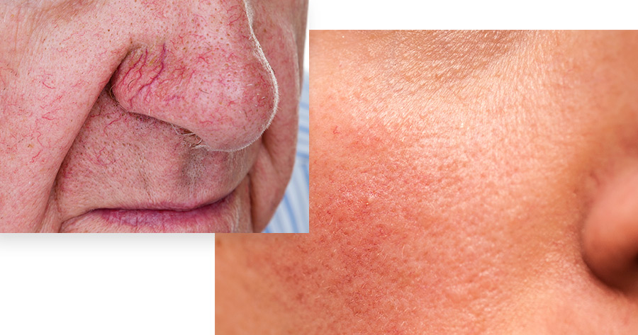 Facial Vein Treatment Service Photo1