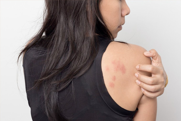 Skin Rash Treatment Nyc Rashes New York